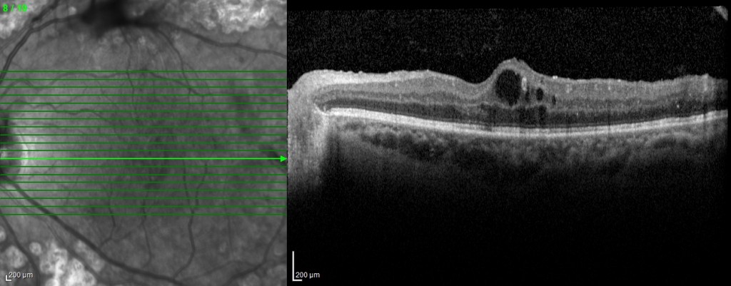 Diyabetik Retinopati2